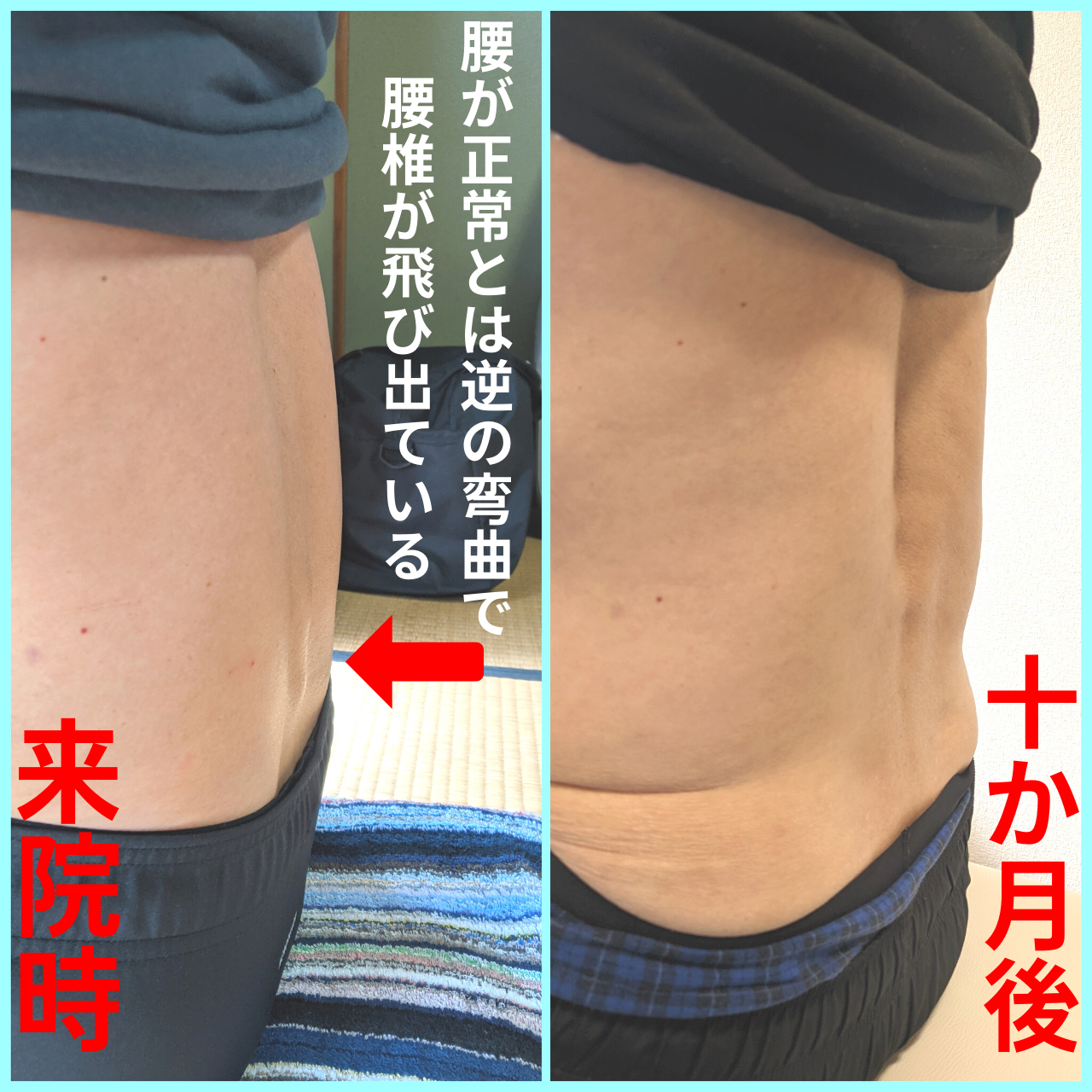 脊柱管狭窄症をLAMP脊椎椎間法で改善した証明。滋賀県大津市あゆは整体院
