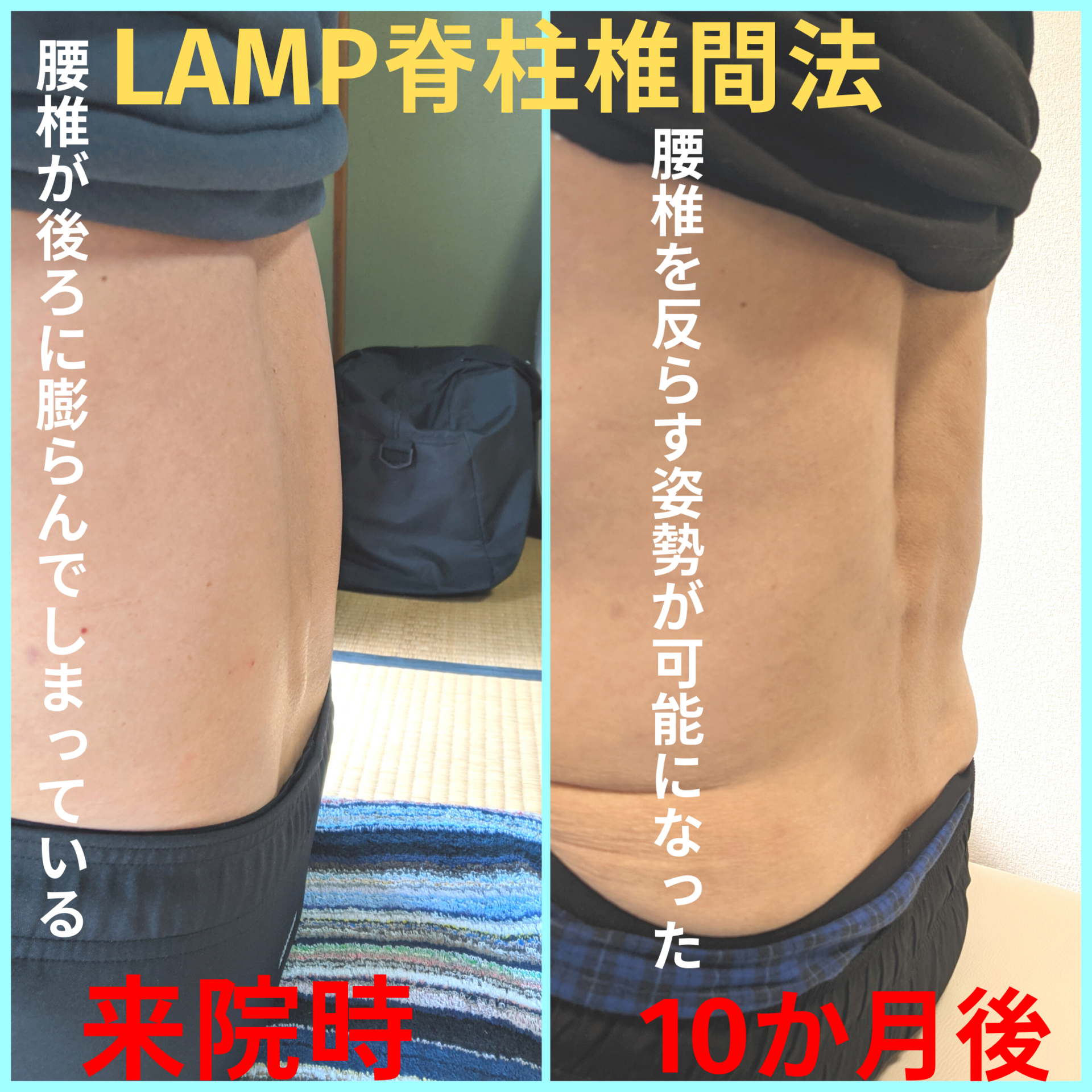 脊柱管狭窄症で腰痛の患者様-2
