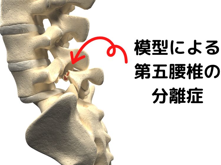 第五腰椎分離症の骨のイラスト