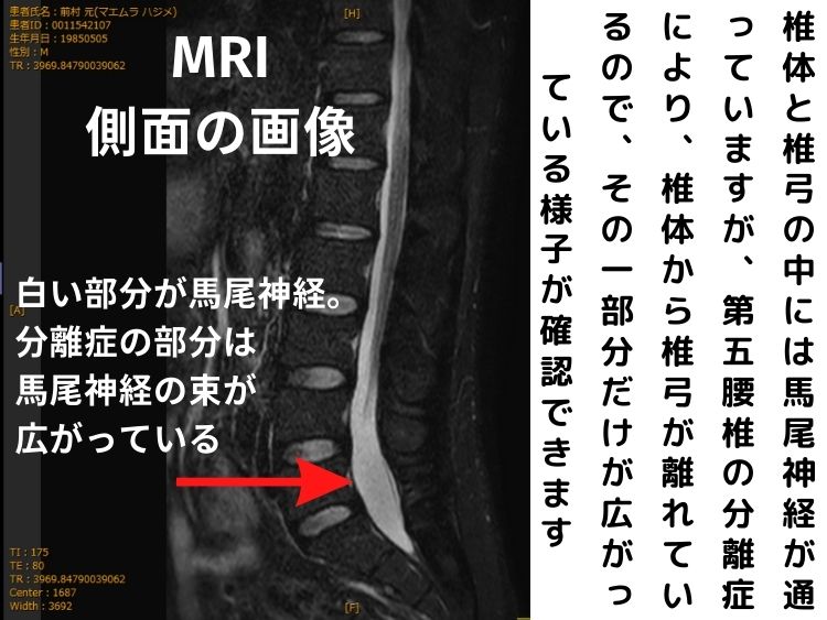 分離症による馬尾神経の膨らみの様子