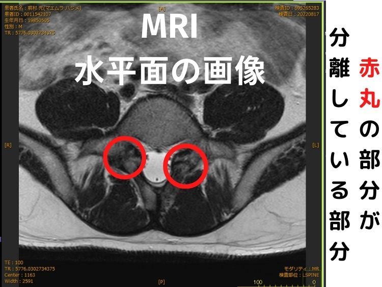 腰椎分離症の水平面のMRI画像