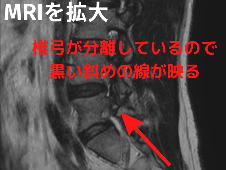 腰椎分離症の横から見たMRI画像