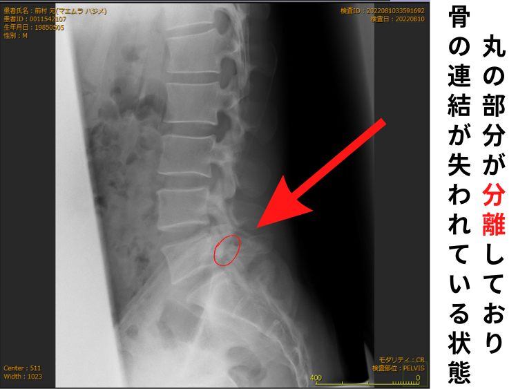 腰椎分離症のレントゲン画像