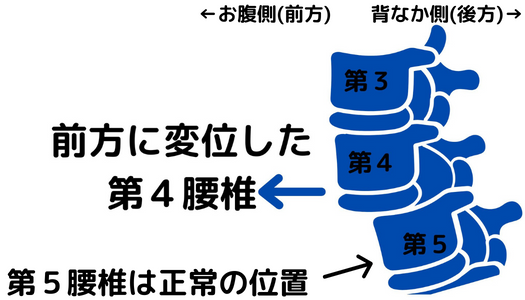 腰椎すべり症のイラスト画像